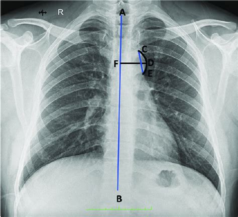 Chest Radiograph Showing Different Download Scientific Diagram