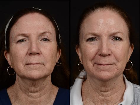 Co2 Laser Resurfacing For Skin With Dark Spots And Sun Damage Before