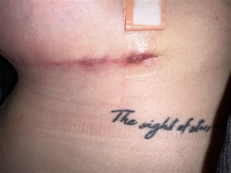 Struggling to remove spitting stitch? : r/Reduction