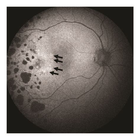 Fundus Autofluorescence Faf Right Eye At Baseline Note The Laser