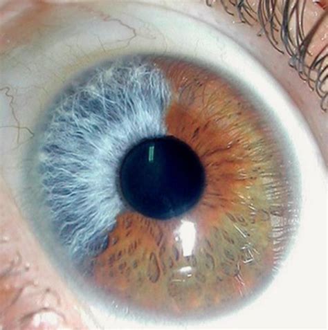 Partial Heterochromia Of Iris Medizzy