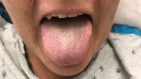 Black hairy tongue: What is it, and how do you get it