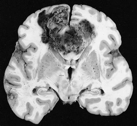 Researchers Identify Enzyme Involved In Deadly Brain Tumors