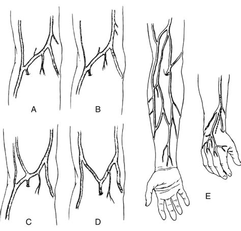 Arm Veins For Lower Extremity Arterial Reconstruction Thoracic Key