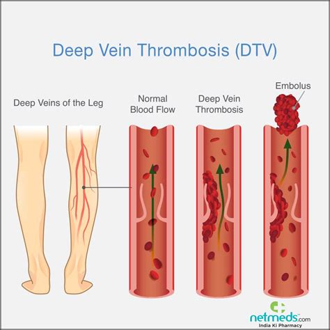 Deep Vein Thrombosis Dvt Symptoms Causes And Off