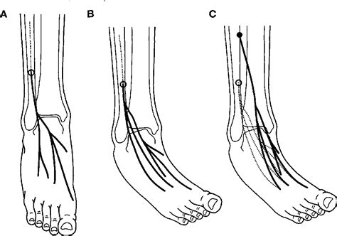 Figure 2 From Tension Neuropathy Of The Superficial Peroneal Nerve