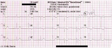 Dr Smiths Ecg Blog Are These Wellens Waves