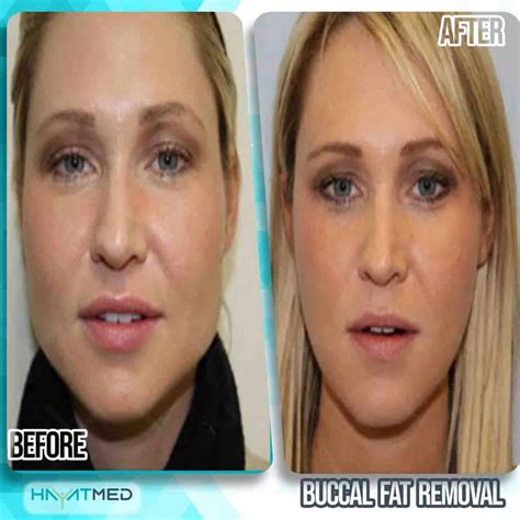 Cost Of Buccal Fat Removal Best Doctors And 2023 Price