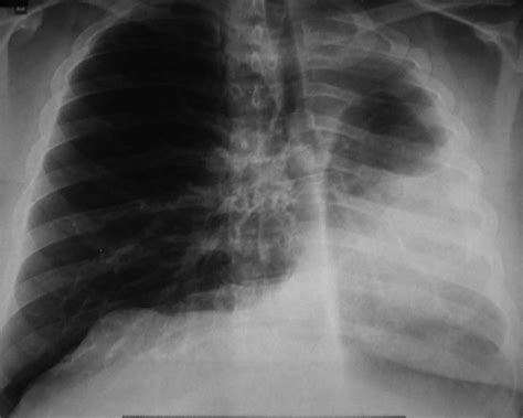Posteroanterior Chest Radiograph Showing Opacification Of The Left