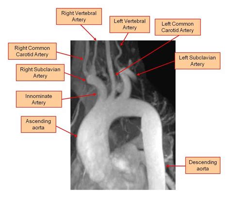 Subclavian Steal Syndrome Symptoms Diagnosis And Treatment