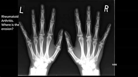 Rheumatoid Arthritis Hands X Ray