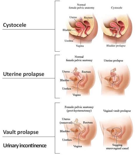Types Of Pelvic Organ Prolapse Macobgyn Urogyn Prolapse Bladder Prolapse Uterine Prolapse