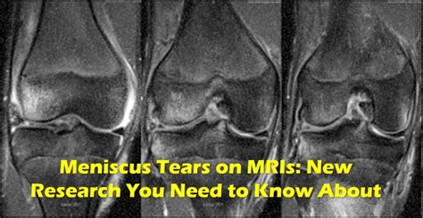 Meniscus Tear Mri Please Read This