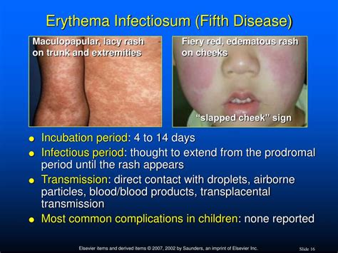 Why Is Erythema Infectiosum Called Fifth Disease