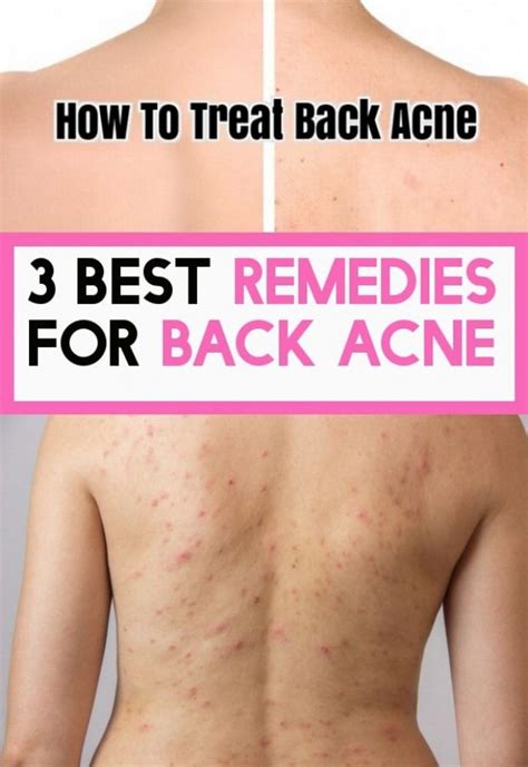 3 Best Remedies To Back Acne In 2020 Best Acne Remedies Back Acne