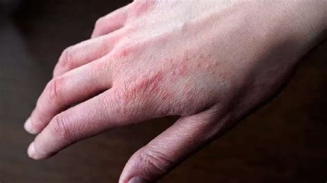 Stress Rash Spotting And Treating It Photo Examples