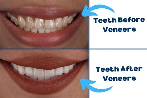 Dentures Vs Veneers The Differences Whats The Better Choice