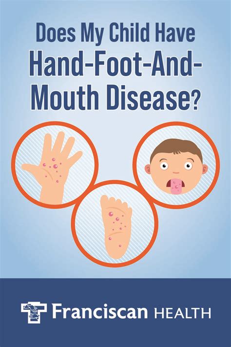 Does My Child Have Hand Foot And Mouth Disease Franciscan Health