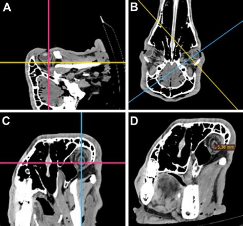 Multiplanar Reconstruction Mpr Of Non Contrast Ct Images In A Soft