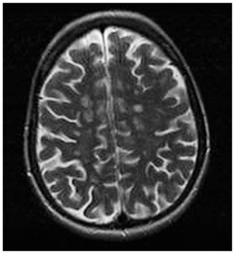 Brain Mri In Multiple Sclerosis Shows Multiple Lesions Hyper Intense