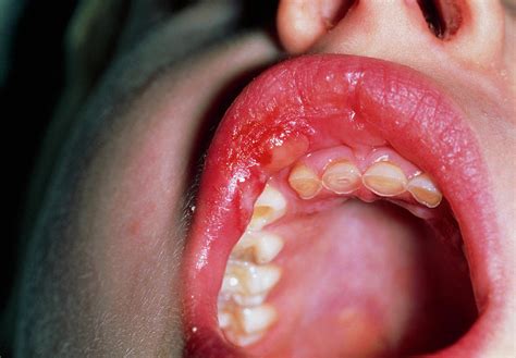 Swollen Lip Of A 6 Year Old Boy From Latex Allergy Photograph By Dr P