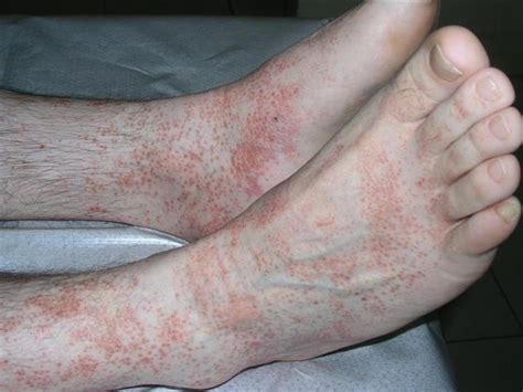 Lichenoid Dermatitis Pictures Photos