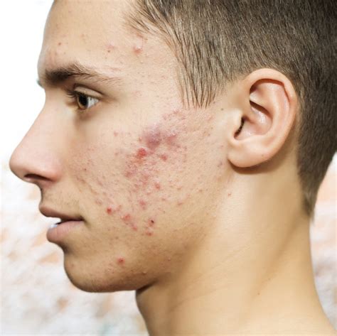 Male Acne Causes