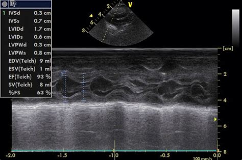 Echocardiography Showing Normal Interventicular Septum Ivs Thickness