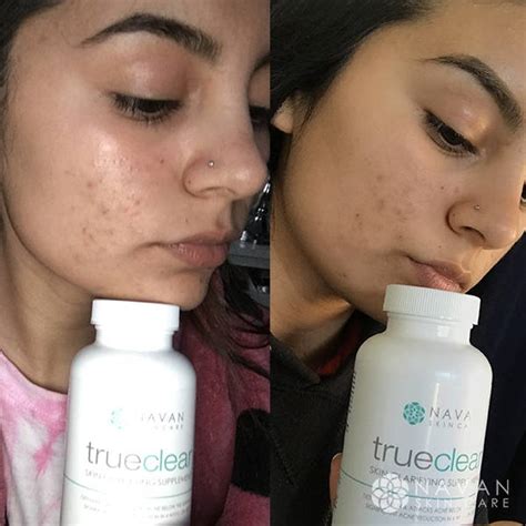 Trueclear Acne Treatment Before And After Navan Skin Care