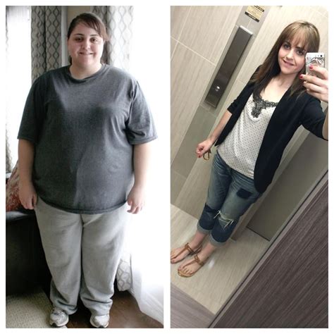 Pin On Bariatric Surgery Before And After