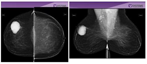 For every 100 women called back after a routine screening mammogram, about 81 do not have breast cancer. Are Your Breasts Dense? | The GW Cancer Center