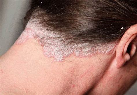 Scalp Psoriasis Pictures Symptoms And Pictures