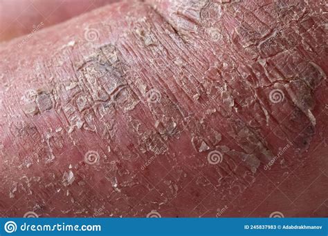 Closeup Of Cracked And Dry Skin Disease Medical Healthcare Concept