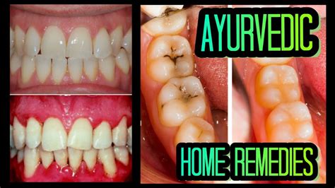 Easy Ayurvedic Remedies For Healthy Teeth And Gums Youtube