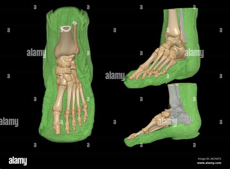 3d Rendering Of The Foot Bones For Diagnosis Bone Fracture And