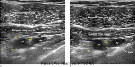 Ultrasound Guided Infraclavicular Brachial Plexus Block Nysora The