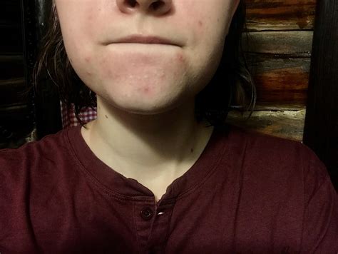 Skin Concerns I Have Had These Persistent White Bumps On My Chin For