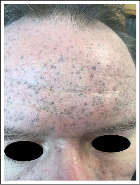 Figure 1 From Blue Grey Hyperpigmentation In Acne After Vandetanib