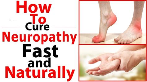 10 Ways To Cure Neuropathy Fast And Naturallyhow To Cure Peripheral
