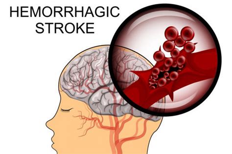 Accidentul Vascular Cerebral Hemoragic Simptomatologie Si Debut