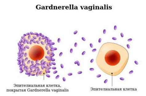 Гарднереллез гарднерелла лечение у женщин и мужчин симптомы