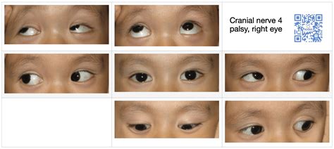 Cranial Nerve Palsy Rd Nerve Palsy Th Nerve Palsy Th Nerve Palsy