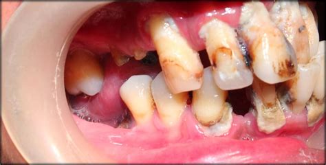 Full Mouth Implants For A Severe Pyorrhea Gum Disease Situationfor A