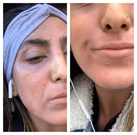 Before And After Minimum Product Healing Reczema