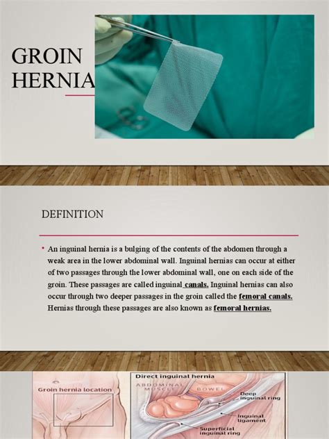 Groin Hernia Pdf Medical Specialties Clinical Medicine