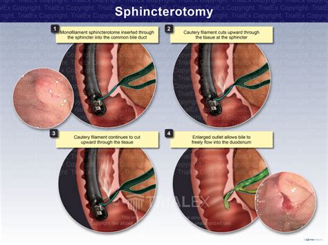 Sphincterotomy Trial Exhibits Inc