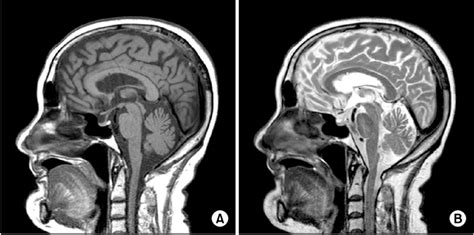 In T1 A And T2 B Weighted Sagittal Mri Of Brain Normal Pituitary