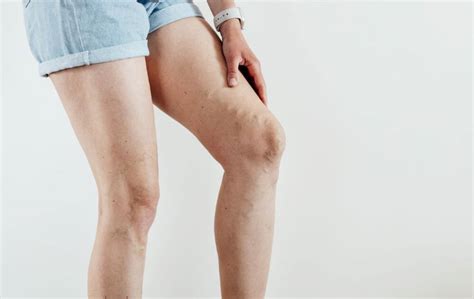 What Your Leg Pain Is Telling You Usa Vein Clinics