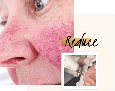 Facial Redness Treatment With Ipl Lasers At Define Medical Clinic