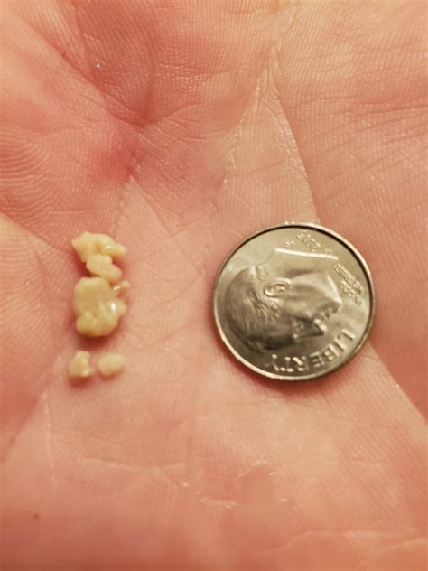 Tonsil Stones I Just Popped Unfortunately I Didnt Get A Videobut